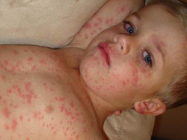 У сусідній із Закарпаттям Румунії від кору померло 46 осіб